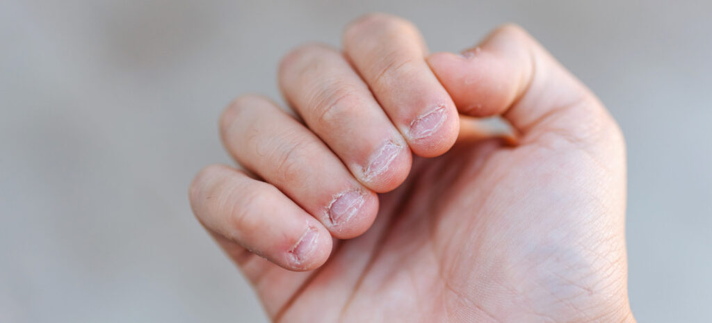 ציפורניים כסוסות לפני טיפול בפרחי באך 