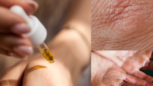 אקזמה ביד והטיפול באקזמה עם פרחי באך